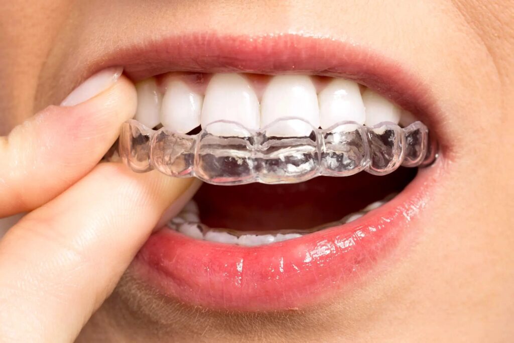 Invisible Aligners